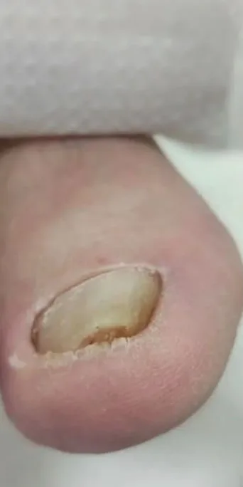 Care for a thickened, deformed toenail (onychogryphosis). — Before