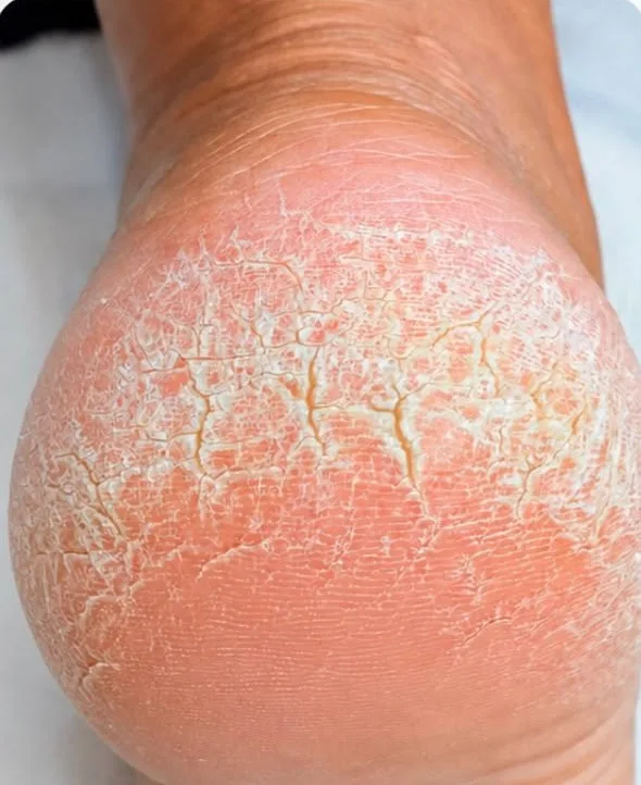 Care for cracked heels and calluses. — Before
