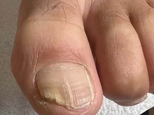 Fungal Nail Care